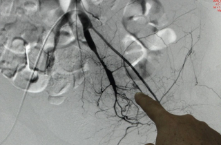 Kỳ lạ ca bệnh chảy máu không cầm