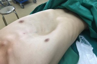 Nâng ngực cho... chàng trai tuổi 18