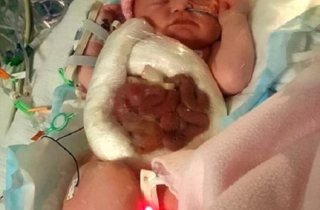 Xót xa hình ảnh bé gái bị xổ ruột bẩm sinh