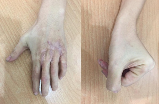 Giữ lại vân tay cho cô gái bị cán nát tay