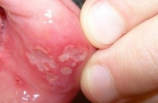 Bỗng dưng sưng nướu, lở miệng thì làm sao?