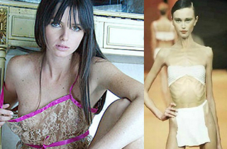 Chứng biếng ăn giết chết nhiều người mẫu ép cân siêu gầy