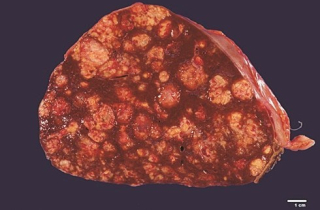 Không phải rượu bia, đây mới là sát thủ gây ung thư gan âm thầm cho người Việt