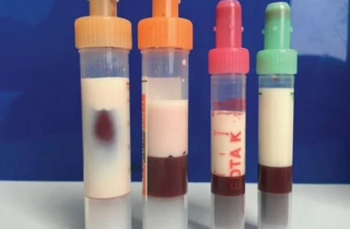 Bác sĩ sốc khi phát hiện người đàn ông 39 tuổi có máu màu trắng sữa