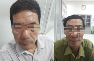 Vào bệnh viện tẩy đốt nốt ruồi, tá hỏa khi biết mình bị ung thư