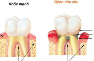 Đánh răng sai cách là nguyên nhân gây ra nhiều bệnh ung thư