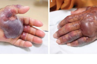 Người đàn ông bị cắt cụt tay vì món ăn tươi sống nhiều người yêu thích