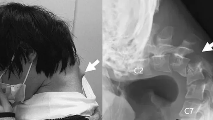 Nhìn điện thoại quá nhiều, nam thanh niên không thể ngẩng đầu