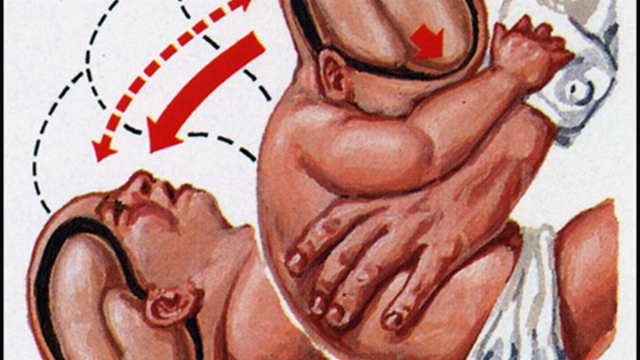 Bố lắc con để ru ngủ khiến em bé 4 tháng tuổi bị bại não