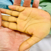 Sụt cân, mệt mỏi - cảnh báo sớm của ung thư gan ít ai ngờ