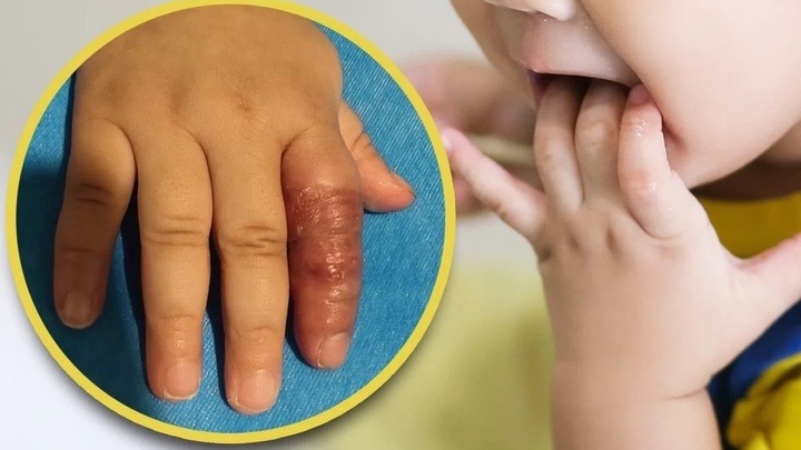 Mẹ dùng băng quấn để ngăn con mút tay, em bé suýt phải cắt cụt ngón