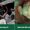 Phẫu thuật nội soi hoàn toàn cắt u đại tràng 5cm cho du khách Canada