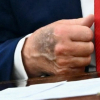 Bàn tay thâm tím của ông Trump gây chú ý