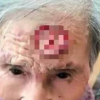 Cụ bà 98 tuổi dùng kéo cắt 'sừng trường thọ' trên trán, dẫn đến nguy kịch
