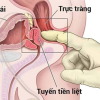 Triệu chứng điển hình của phì đại tuyến tiền liệt