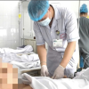 Xương cá đâm thủng ruột non, gây áp xe ổ bụng