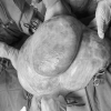 Bụng to tưởng béo, người phụ nữ không ngờ mang khối u buồng trứng 15kg