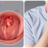 9 dấu hiệu ung thư vòm họng giai đoạn đầu