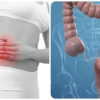 8 dấu hiệu ung thư đại tràng tuyệt đối không nên bỏ qua