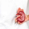 Chỉ còn một quả thận có phải đối mặt với nguy cơ suy thận sớm?