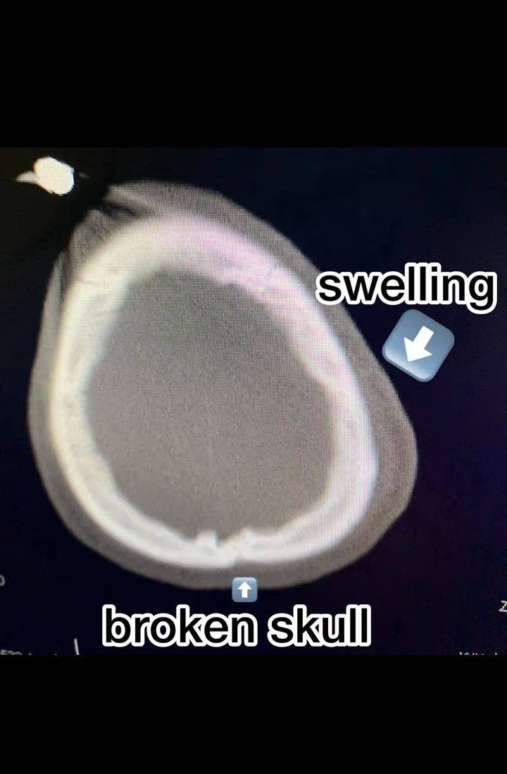 Anh bị chấn thương sọ não nghiêm trọng.