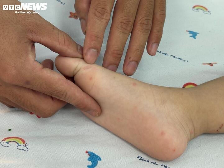 BS khuyến cáo, khi trẻ có các triệu chứng như sốt cao không hạ, nổi bóng nước ở tay, chân, phụ huynh cần đưa trẻ đến bệnh viện ngay.