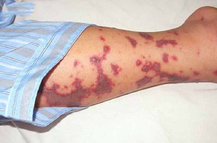 Não mô cầu tăng mạnh so với cùng kỳ năm trước (Ảnh minh họa)