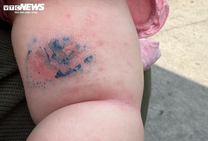 Thời tiết nắng nóng kéo dài làm gia tăng các bệnh da liễu.