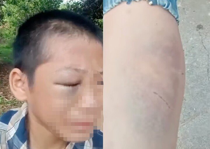 Hình ảnh cháu N.H.T nghi bị bạo hành