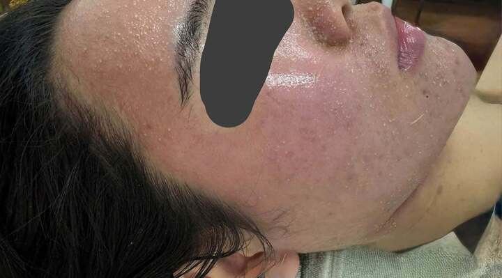 Mặt sưng phù, nổi kín mụn sau vài lần dùng mỹ phẩm dưỡng trắng mua trên mạng (Ảnh: BVCC)