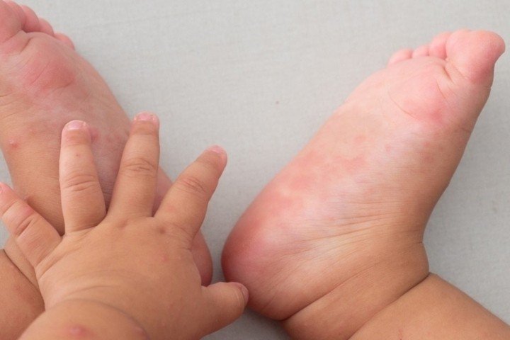Tay chân miệng là bệnh truyền nhiễm thường gặp ở trẻ nhỏ, đặc biệt dưới 5 tuổi. (Ảnh minh hoạ)