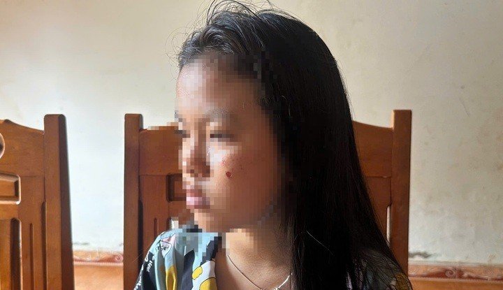Vết bỏng trên mặt T.