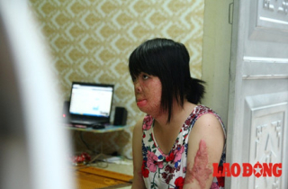 Cô gái bị chồng thiêu sống gây rúng động 1 năm trước: “Tôi không hận chồng nhưng khó tha thứ“