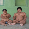 Hai chị em béo phì phải cắt bớt dạ dày để giảm cân
