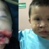 Phẫu thuật tạo hình thành công cho bé trai 2 tuổi bị chó cắn nát mặt