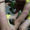 Lại thêm giáo viên đánh thâm tím tay học sinh tại Thái Bình