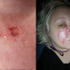 Vết sẹo thủy đậu trên mặt người phụ nữ phát triển thành ung thư
