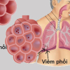 Cách phòng bệnh viêm phổi hiệu quả trong thời tiết nồm, ẩm