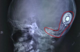 Thanh âm đầu đời của cô bé nghèo 7 năm sống trong thinh lặng