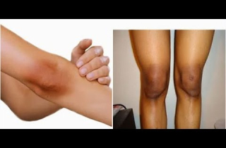Bị bạn trai chia tay chỉ vì đầu gối thâm