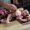 Bé gái Ấn Độ chào đời với 4 chân và 3 tay