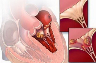 Virus thông thường như cúm, sốt xuất huyết cũng có thể gây viêm cơ tim