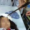 Hà Nam: Bàng hoàng nữ sinh bị bạn phi dao cắm vào trán