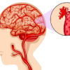 8 dấu hiệu của bệnh xuất huyết não: Ghi nhớ để xử lý sớm có thể cứu sống bạn