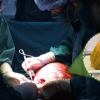 Phẫu thuật thành công u xơ tử cung khổng lồ hơn 10kg cho bệnh nhân