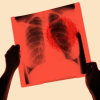 Hơn 50% người bị ung thư phổi tử vong chỉ sau 1 năm: Cần làm gì để phòng ngừa?