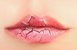 6 thói quen xấu khiến đôi môi nứt nẻ, khô xác