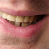 Vàng răng và những cách loại bỏ vàng răng