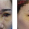 Cô gái Hà Nội bị hỏng mắt sau khi nâng mũi
