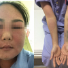 Bôi kem trắng da, cô gái Quảng Ninh phải nhập viện cấp cứu
